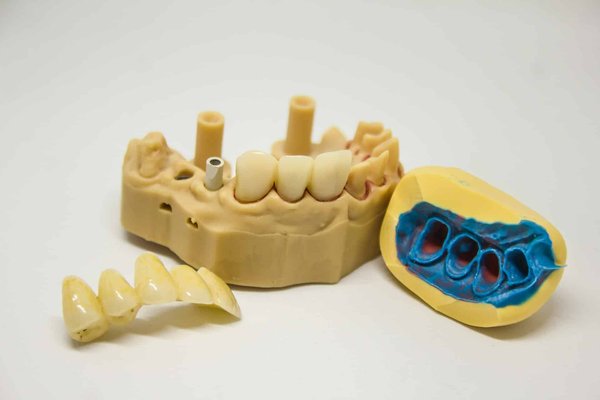 What is the role of 3D printing in customized medical implants?